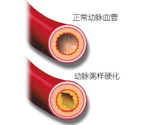 全自动生化分析仪讲解高血脂的危害2