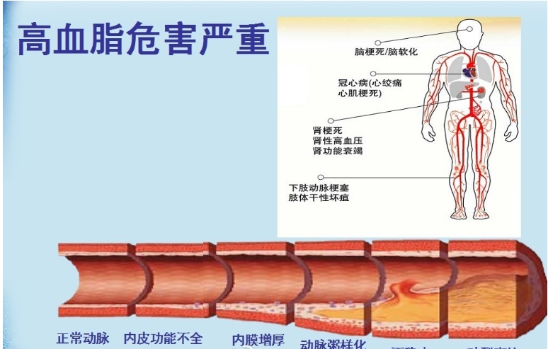 全自动生化分析仪讲解高血脂的危害