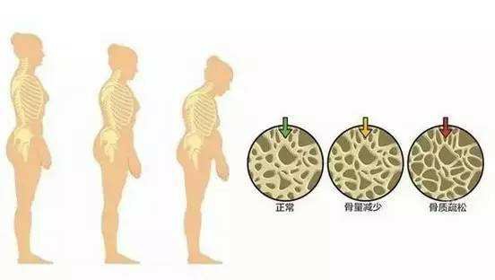 骨密度仪有话说“求你了,别再偷袭我们的骨健康了”