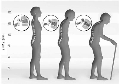 骨密度仪骨质疏松症一种随处可见的现代生活病