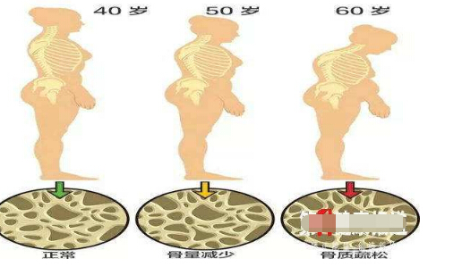 骨密度仪专家浅析通过骨密度筛查 了解骨头健康状况